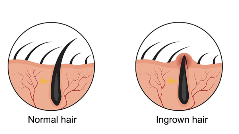 hair growth and treatment guide after waxing with hard wax