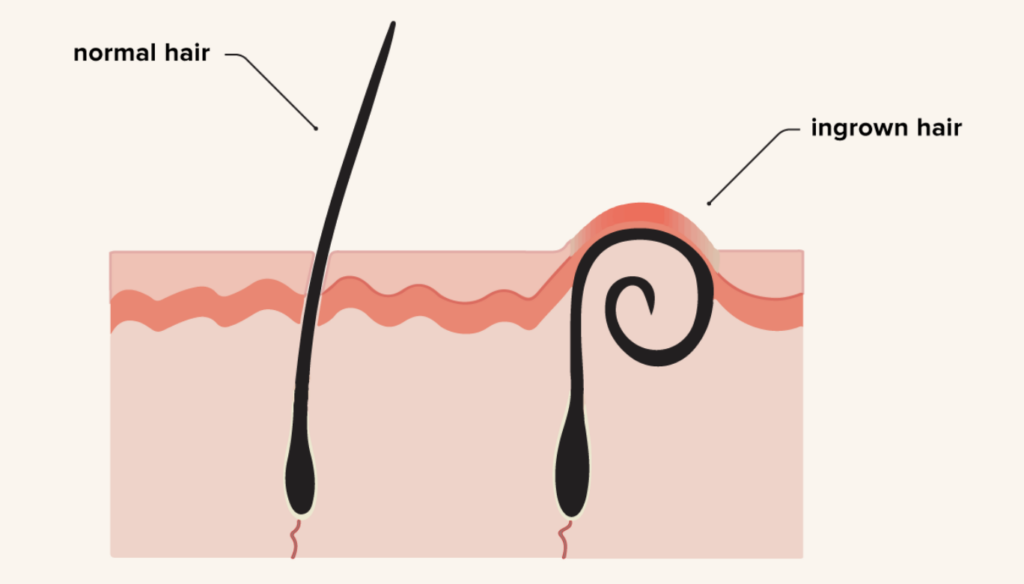 hair growth and treatment guide after waxing with hard wax