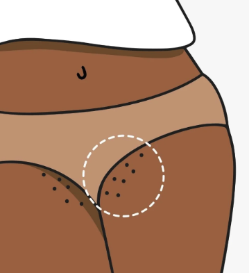 how to lighten bikini area