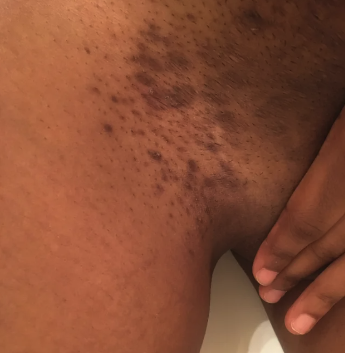 Cómo aclarar la zona del bikini