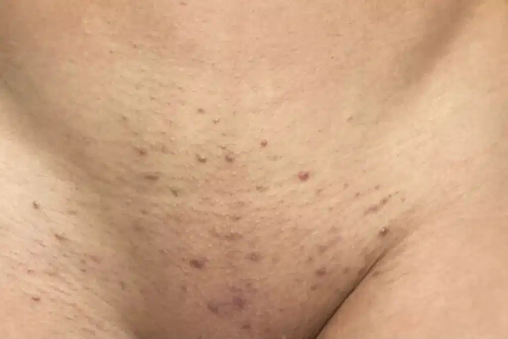 Rash After Waxing
