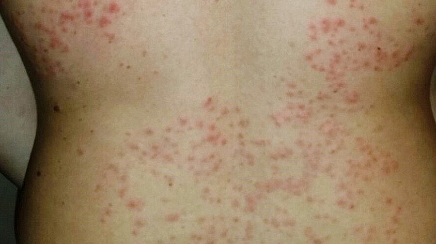 Rash After Waxing